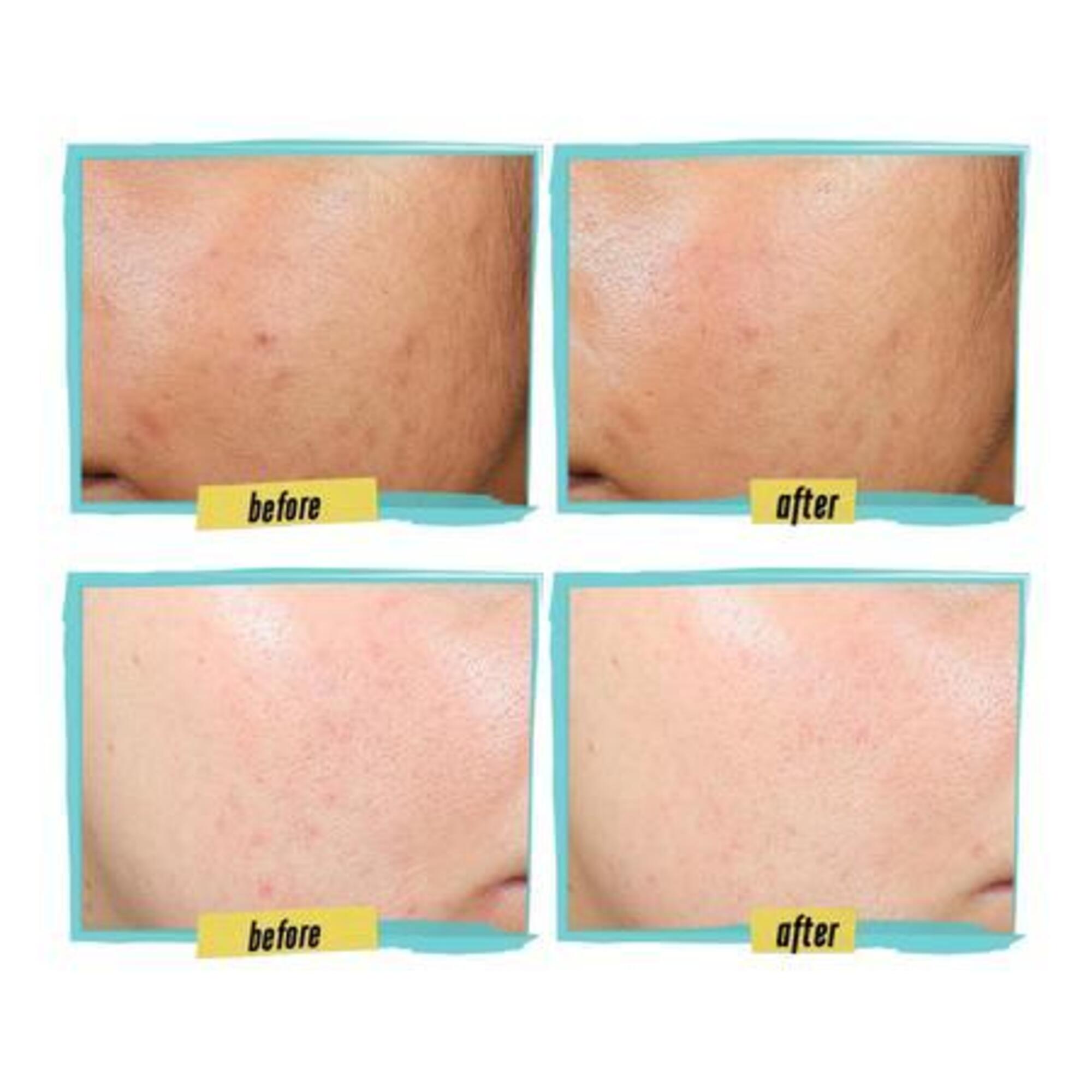 Lotion anti-imperfections