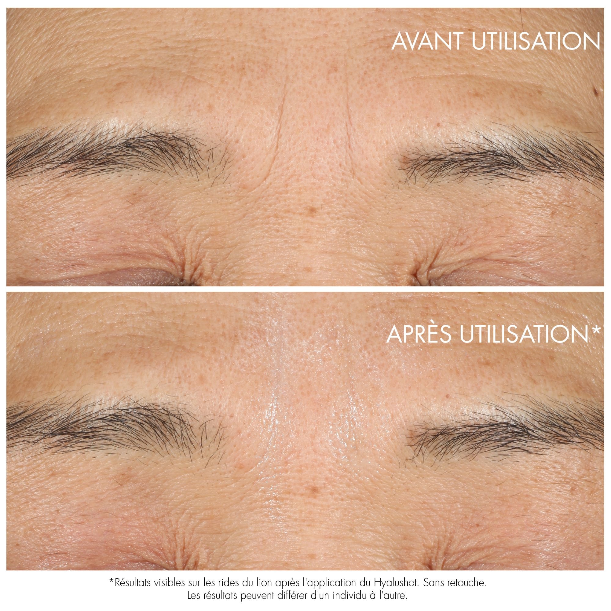 Capture totale hyalushot correcteur de rides installées et 1ers signes de rides