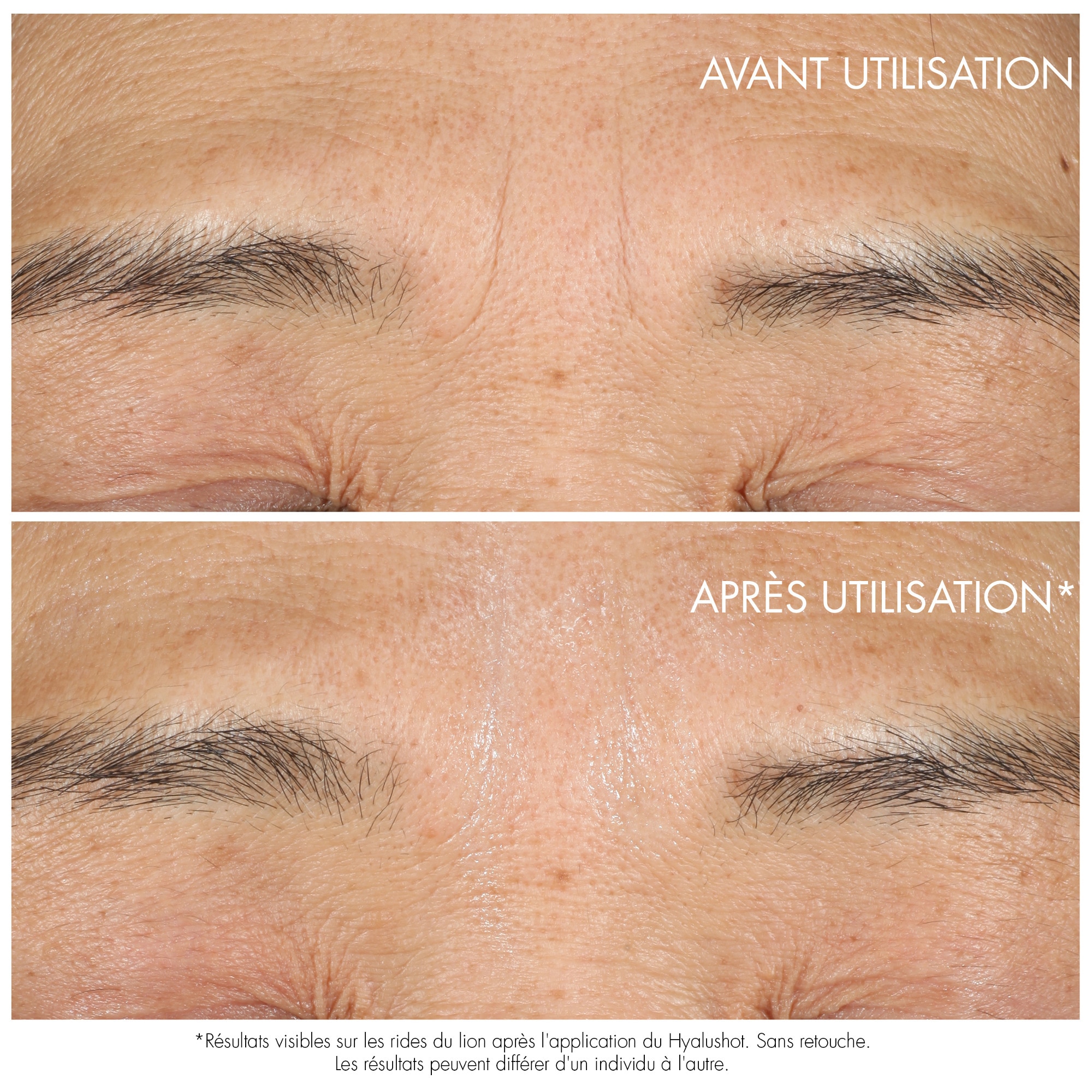 Hyalushot correcteur de rides installées et 1ers signes de rides