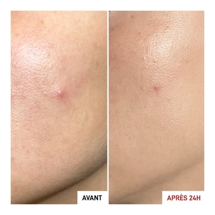 Gel "effet patch" - anti-imperfections - action ciblée en 24h